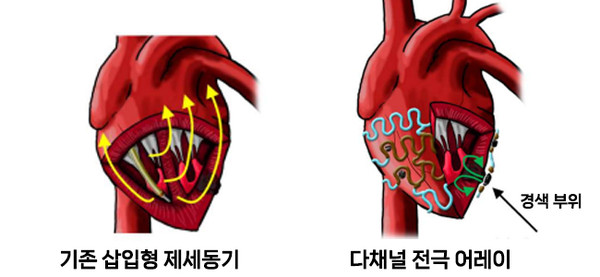 기존 임상에서 사용 중인 삽입형 제세동기와 다채널 전극 어레이의 구조 비교