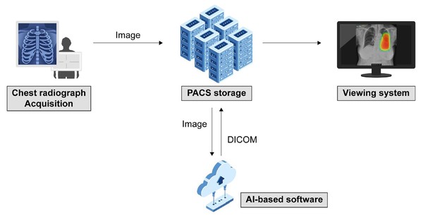 흉부 방사선 영상에서 놓치기 쉬운 조기 폐암 신속한 진단에 AI의 역할