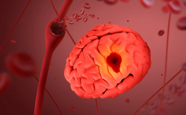 이대뇌혈관병원 진료개시