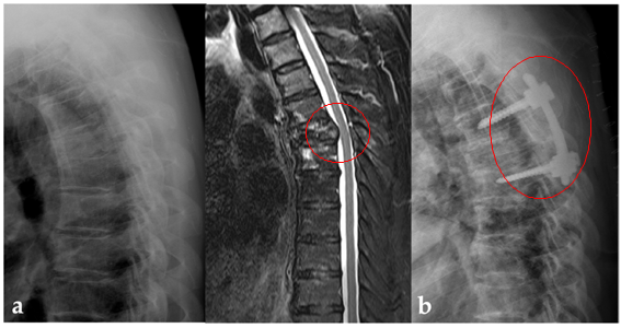 비소세포폐암이 척추로 전이되어 걷지 못했던 50대 환자의 X-ray와　MRI 검사 사진