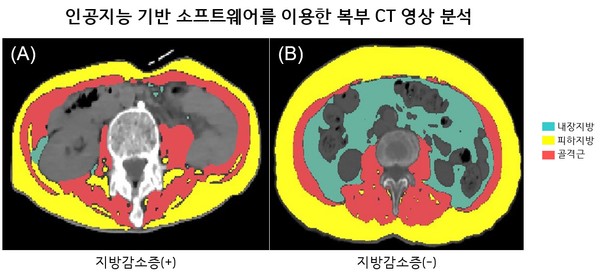 인공지능 기반 소프트웨어로 체성분 분석한 루게릭병 환자의 복부 CT영상. 지방감소증 동반한 환자 (A)는 CT검사 1개월째 사망한 반면, 지방감소증 동반하지 않은 환자 (B)는 35개월(관찰기간) 동안 생존함..