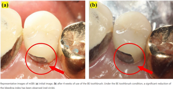 트로마츠 생체전류 칫솔, 임플란트 환자들의 출혈지수 개선 결과 네이처 저널 게재