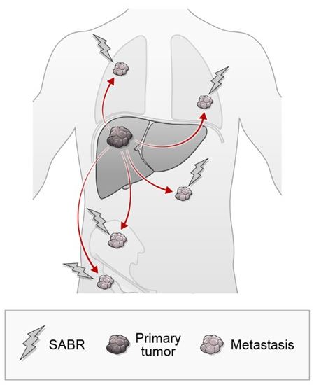 소수 전이성 간암에 시행하는 체부 정위적 방사선치료 원리