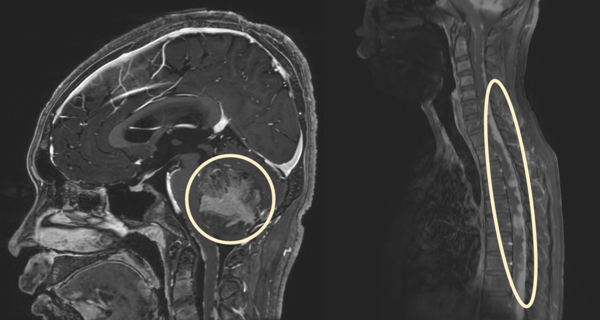 수모세포종 환자의 뇌 및 척수 MRI.  소뇌의 종양(왼쪽) 및 광범위한 연수막 전이(오른쪽)가 나타남