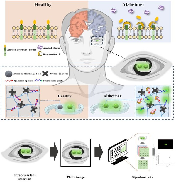 인공수정체형 형광 센서의 모식도. 인공수정체 내에서 역오팔(Inverse Opal) 구조 하이드로겔 센서가 알츠하이머병 특이적 단백질과 반응해 형광 신호를 발현하는 과정을 보여준다. 이렇게 얻은 형광 신호는 이미지 처리를 통해 스마트폰으로도 측정값을 얻을 수 있어 가시적인 모니터링이 가능하다.
