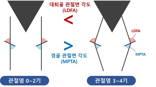절염 심각도별 선천적인 무릎 변수 차이. 관절염 3~4기 환자는 0~2기 대비 대퇴골 관절면 각도(LDFA)가 크고 경골 관절면 각도(MPTA)가 작아, 내반 정렬의 특성이 뚜렷했다.