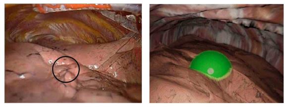 폐결절 위치를 나타낸 실제 흉강경 영상 및 시뮬레이션 영상 캡처