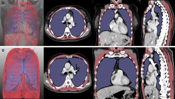 루게릭병 환자의 흉부 CT 분석 결과. 폐 용적 지수(LVI, 보라색)와 호흡근 용적 지수(RMI, 빨간색)가 낮은 환자는 높은 환자보다 생존 기간(위 5개월 vs 아래 43개월)이 짧았다.