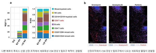 CD8 양성 T 세포로 루프스 신장염의 예후 예측