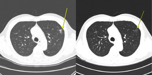 무증상 일시적 면역관련 폐렴 사례